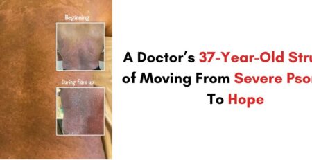 A Doctor’s 37-Year-Old Struggle of Moving From Severe Psoriasis To Hope