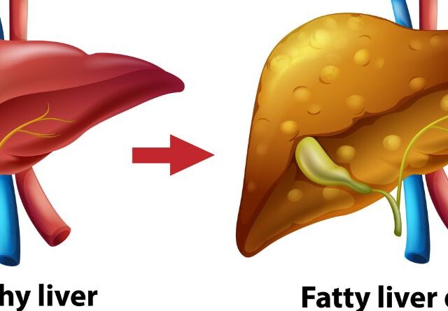 The Truth About Non-Alcoholic Fatty Liver Disease: What You’re Not Being Told